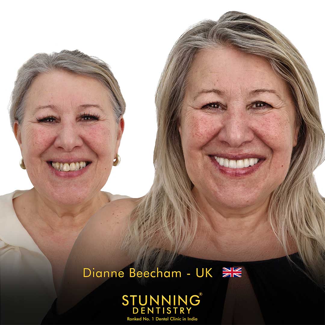 Smile makeover result