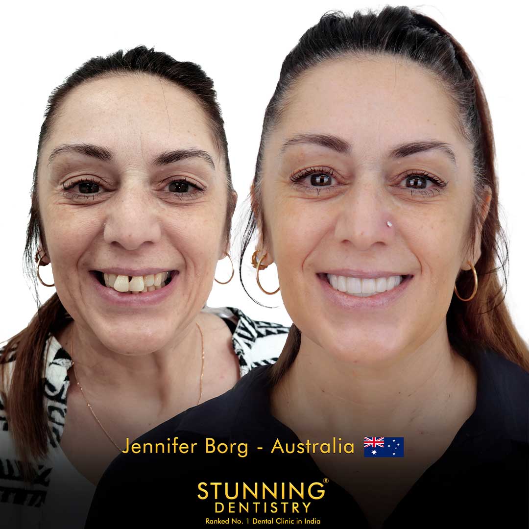 Complex rehabilitation result
