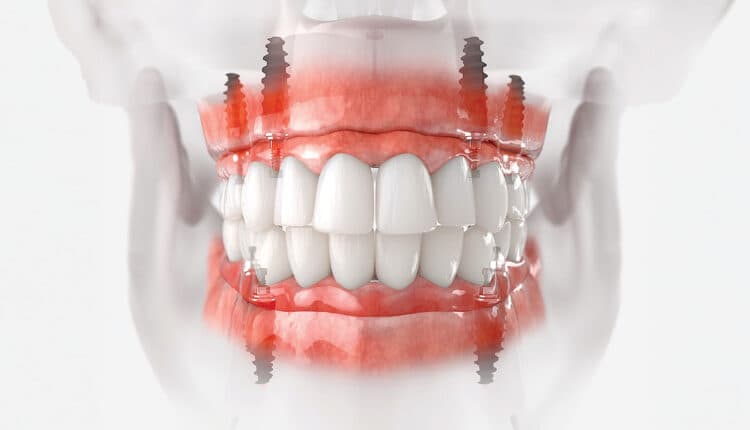 All-on-6 When Bone Allows