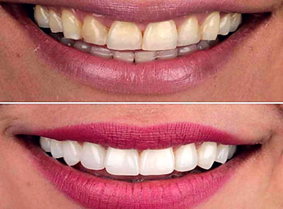 Porcelain veneers before and after