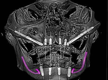 Zygomatic implant 3D CT planning