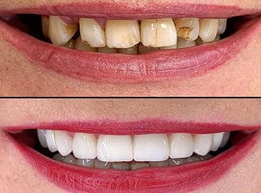 What You Pay at Stunning Dentistry (from Newcastle)