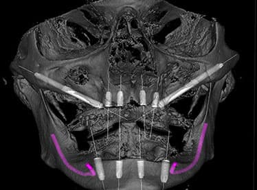Zygomatic Implants Cost: Cardiff vs Stunning Dentistry