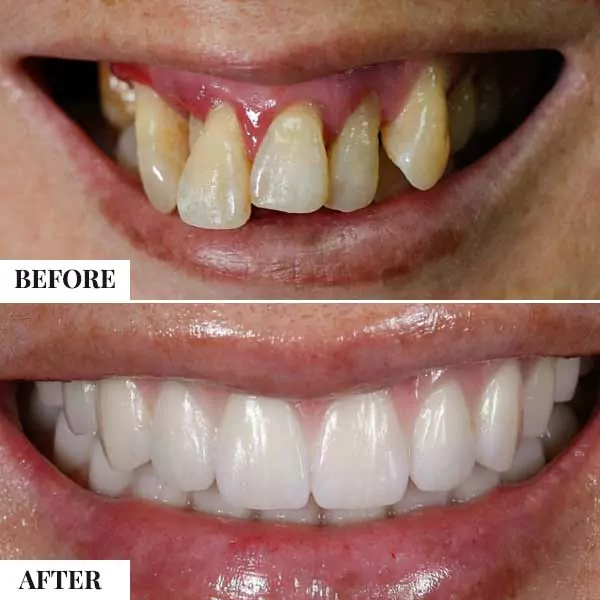 Full Mouth Rehabilitation - photo 2