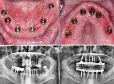 The Provisional Prosthesis, Materials and Engineering