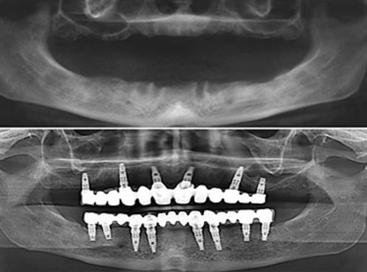Why Choose All-on-6, The Clinical Case