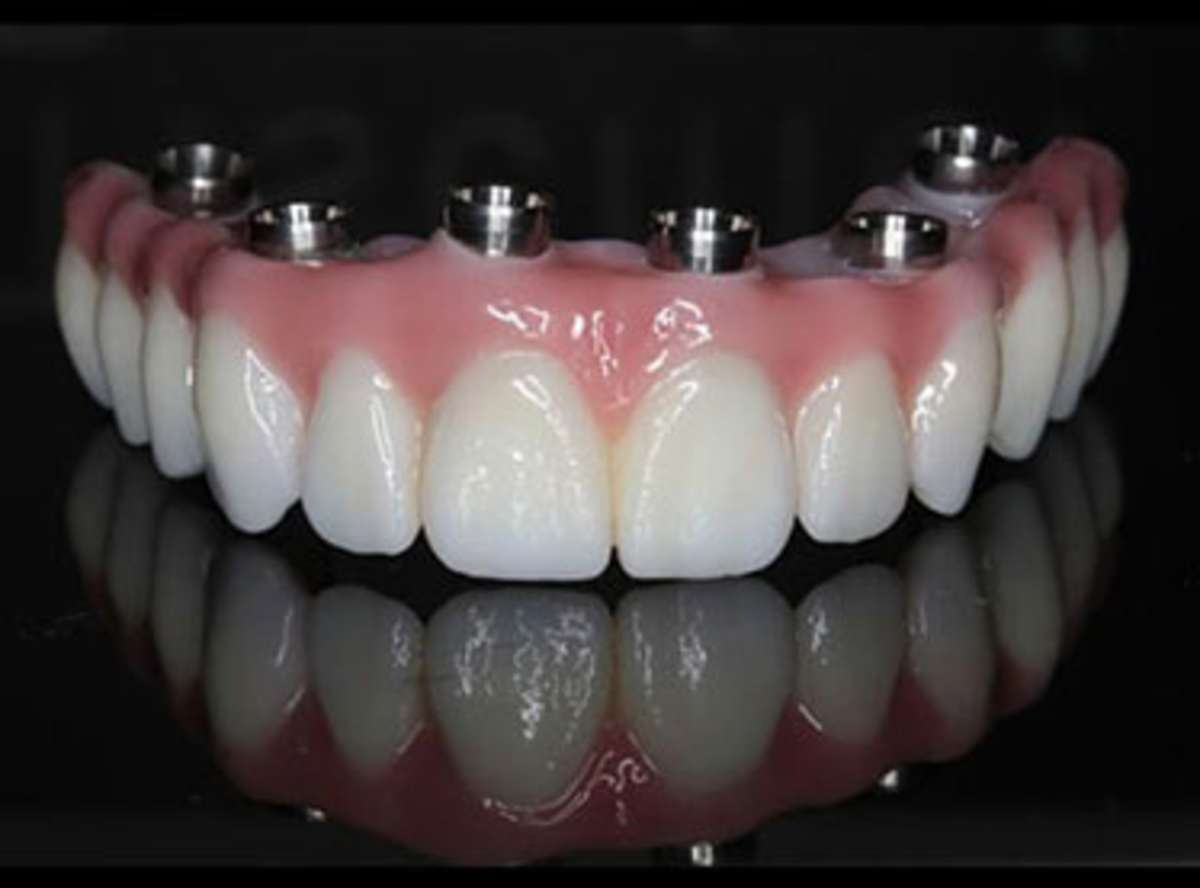 What Is All-on-6 Dental Implants?