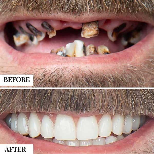 Consequences of Delaying Full-Arch Treatment