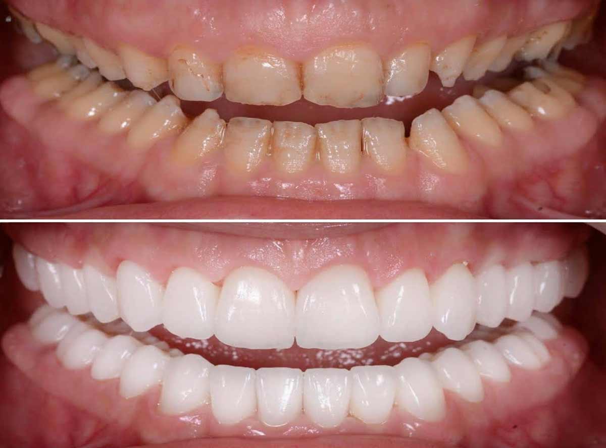 When Full Mouth Rehabilitation Is Indicated