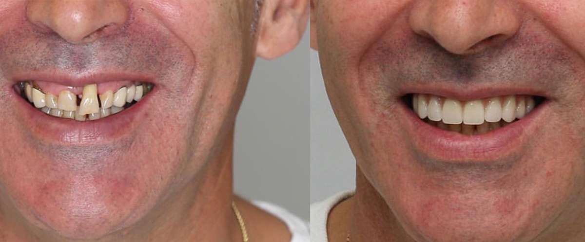 What Full Mouth Rehabilitation Actually Means
