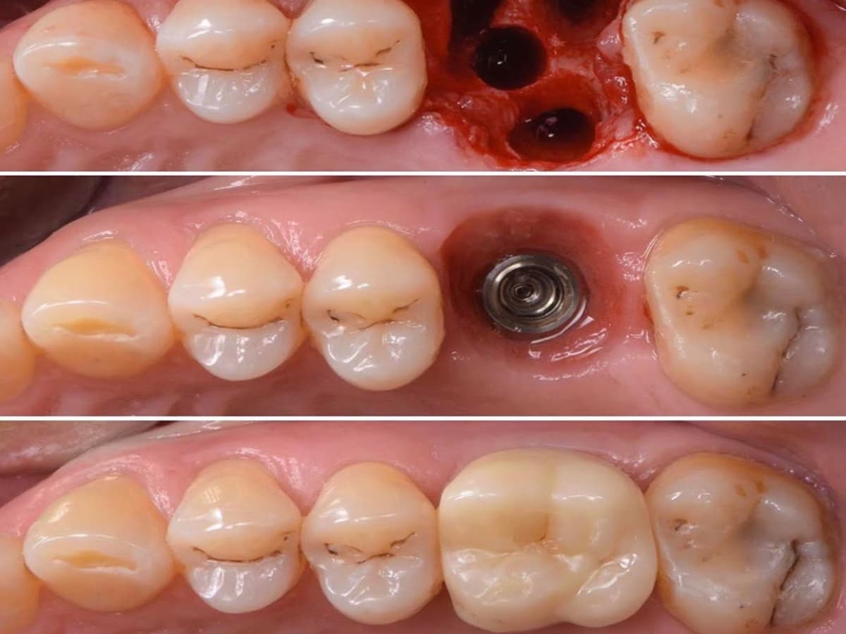 Teeth-in-a-Day vs Delayed-Load Full-Arch Rehabilitation