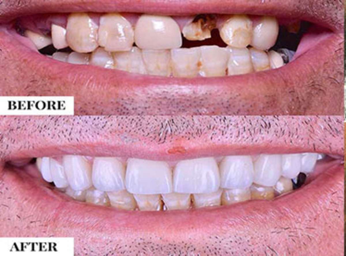 What Is Teeth-in-a-Day?