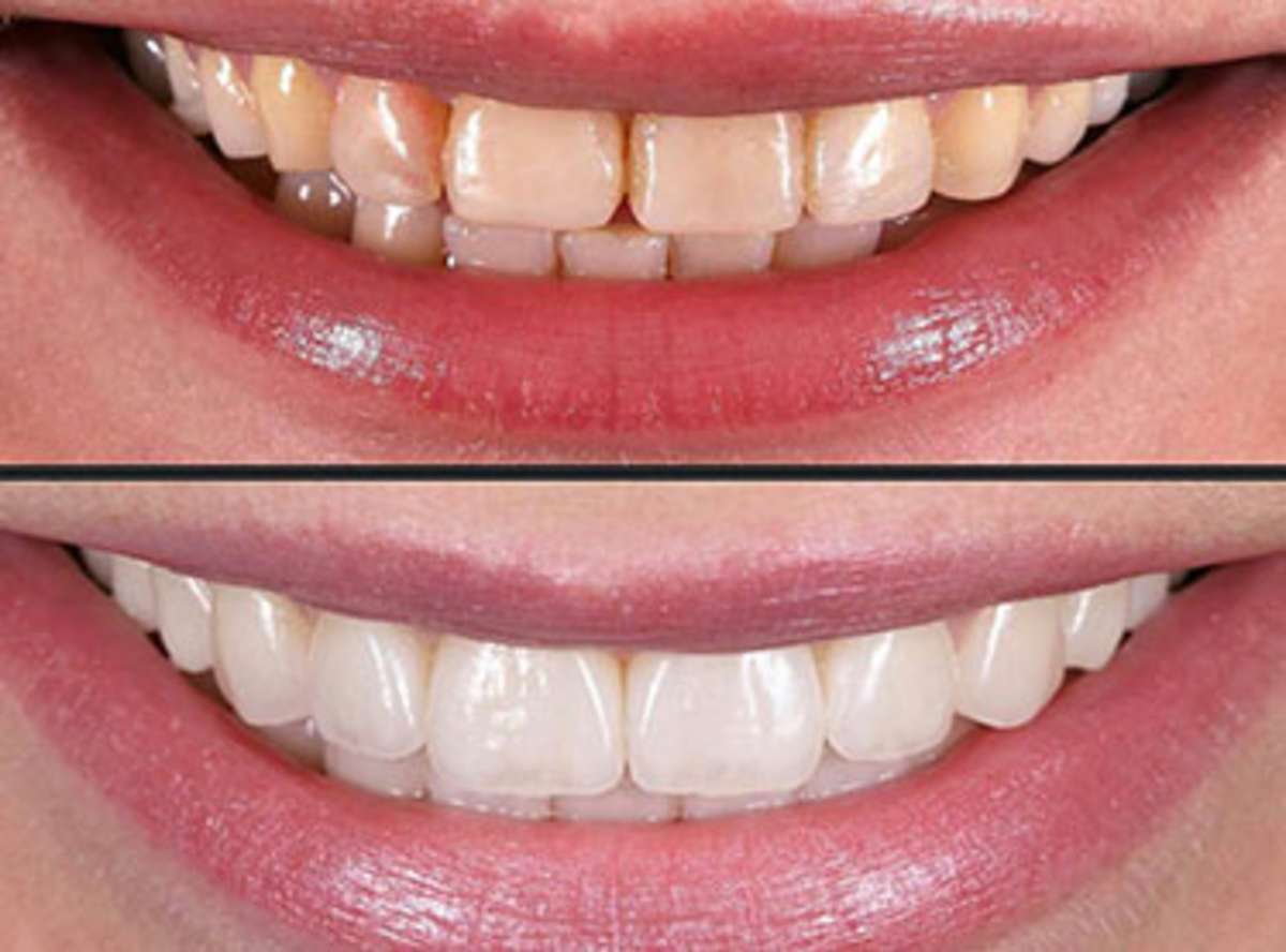 Veneer Systems: E-Max, Porcelain, and Composite Trade-Offs